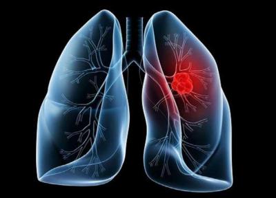 چگونه سرطان ریه و کرونا را از یکدیگر تشخیص دهیم؟