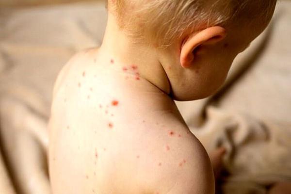 مواظب باشید تب گوجه فرنگی نگیرید ، این بیماری نه آنفلوآنزا است و نه ربطی به گوجه فرنگی دارد ، ویروس تازه فقط بچه ها را مبتلا می کند؟
